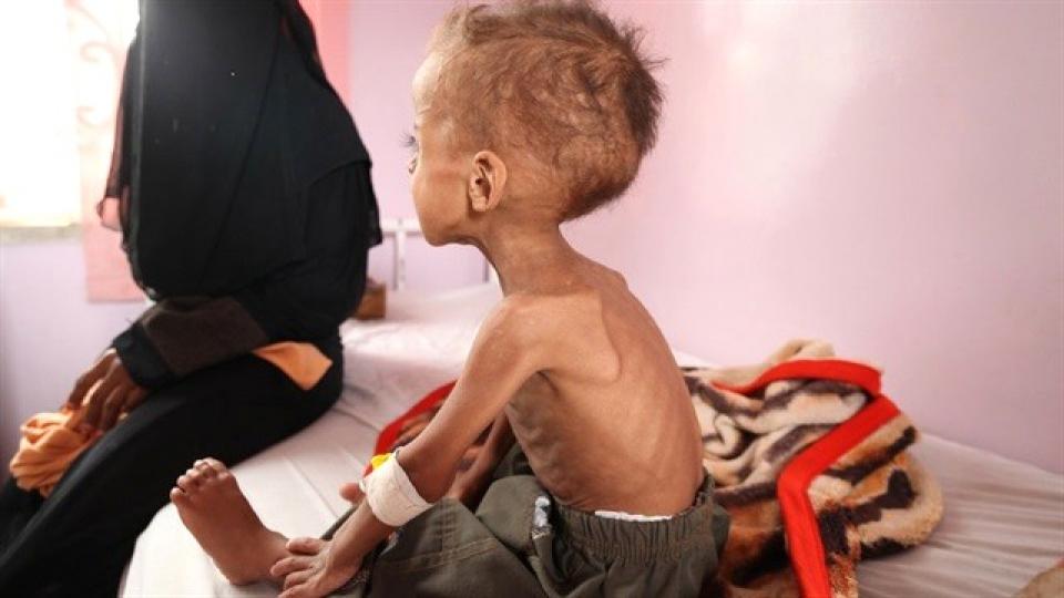 Suud ABD'ye Yardım Ederken Yemen'i Açlıktan Öldürüyor!
